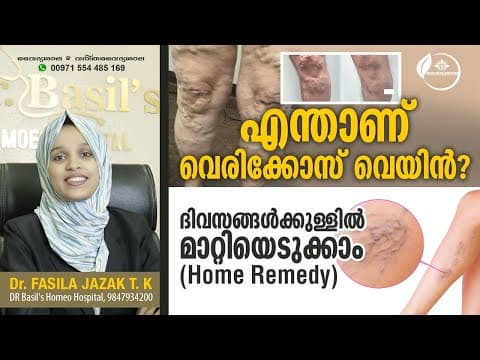 Vericose Vein Treatment Malayalam | വെരികോസ് വെയ്ൻ മാറാൻ | Dr Fasila Jazak